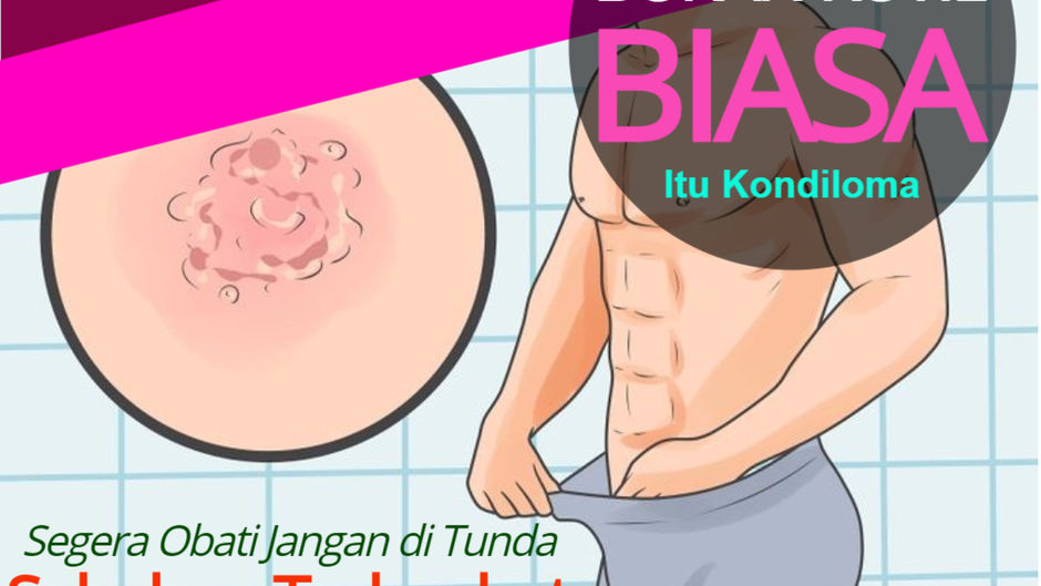 Menghilangkan Kutil Kelamin Dengan Kapur