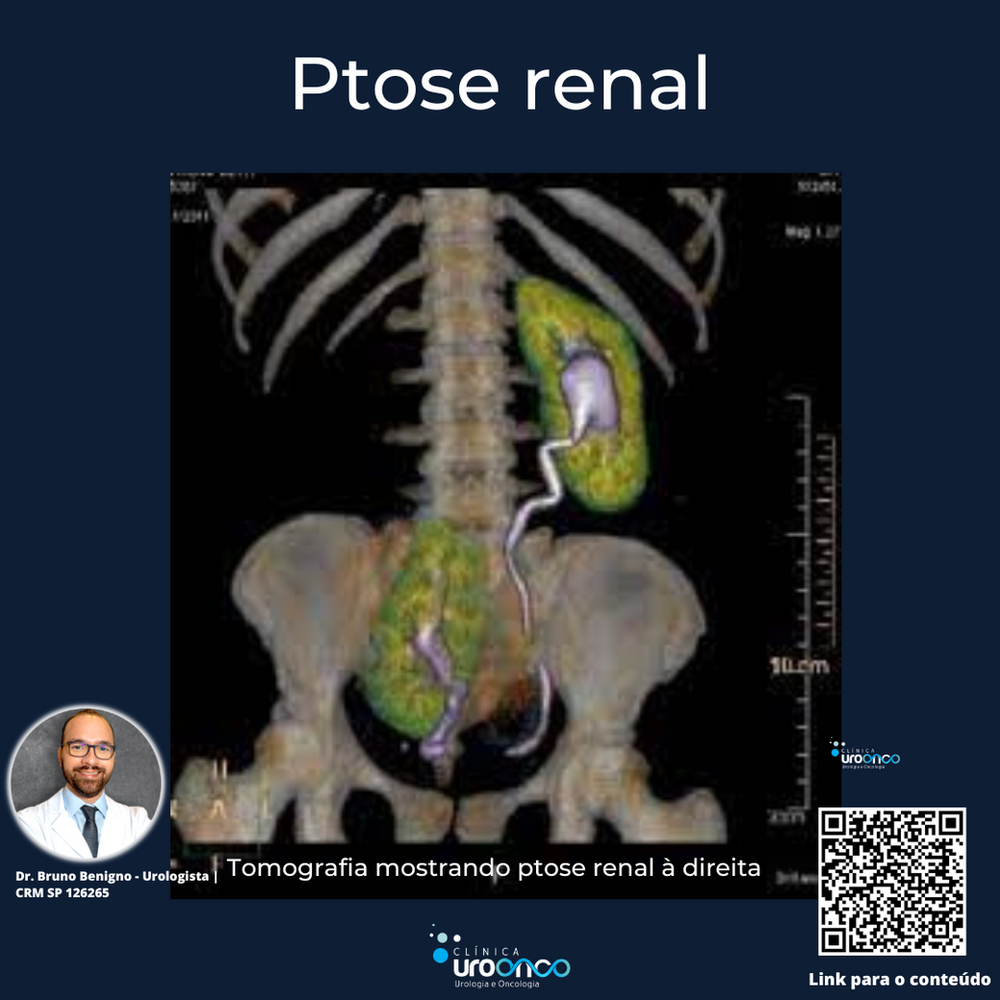 Descubra Como A Ptose Renal Pode Afetar A Sa de E Como Poss vel Descubra Como A Ptose Renal Pode Afetar A Sa de E Como Poss vel