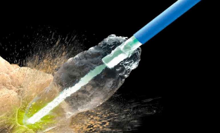 Tecnologia a Laser HoLEP