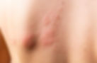 skin breaking out in hives rash following allergic reaction