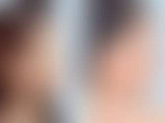Trải Nghiệm Nâng Mũi Cấu Trúc Sau 30 Ngày Tại Việt Mỹ – Thực Tế Hồi Phục & Ổn Định Dáng Mũi