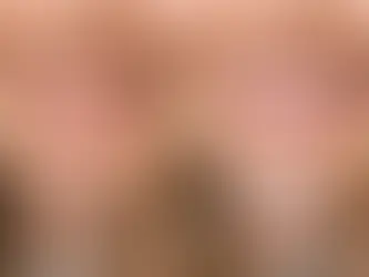 Veneer Transformation Before After Results
