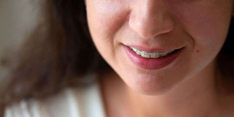 Dientes apiñados
