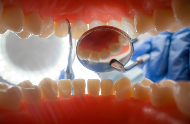 qué es el torus mandibular