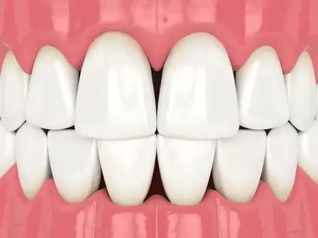 Troneras dentales: qué son, por qué aparecen y cómo se pueden tratar
