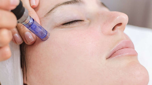 microneedling-1170x658.jpeg