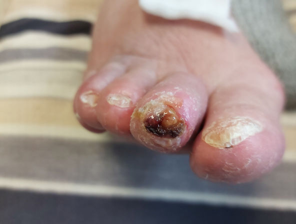 ...der diabetische fuß...