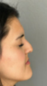 RINOPLASTÍA ANTES 2