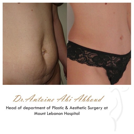 Abdominoplasty before and after — case 2