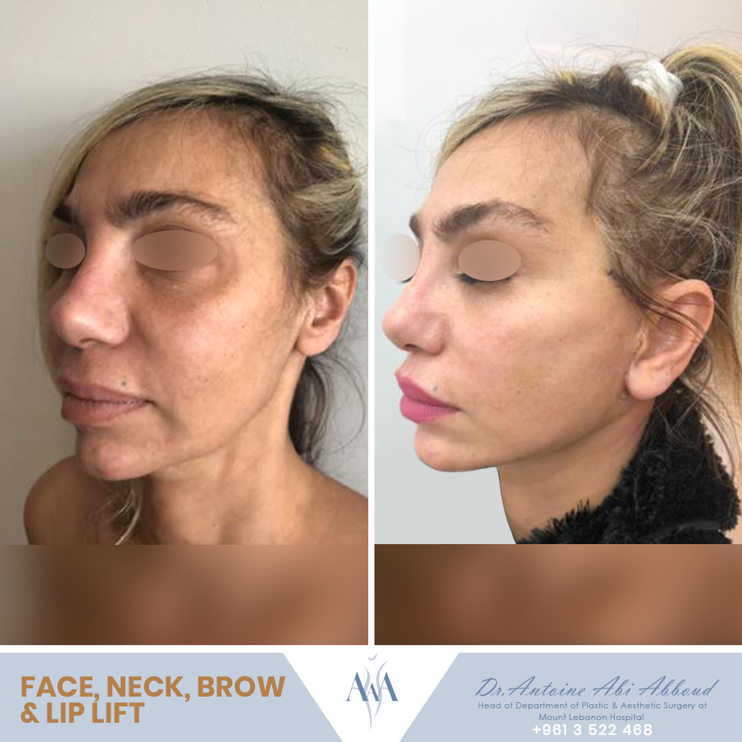 Brow Lift before and after — case 3