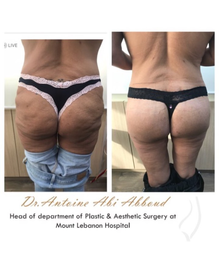Butt Lift before and after — case 2