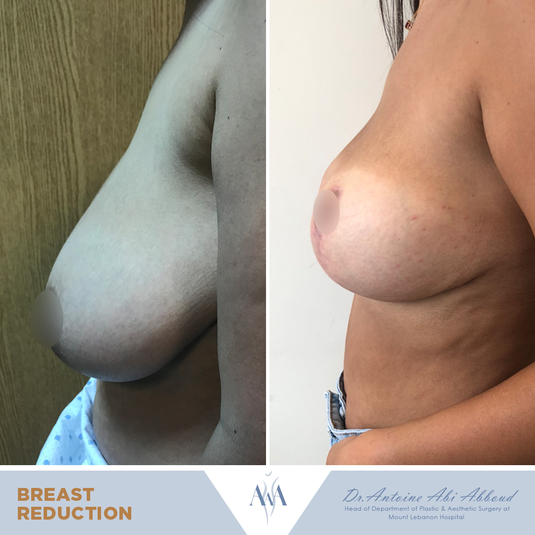 Breast Reduction before and after — case 3