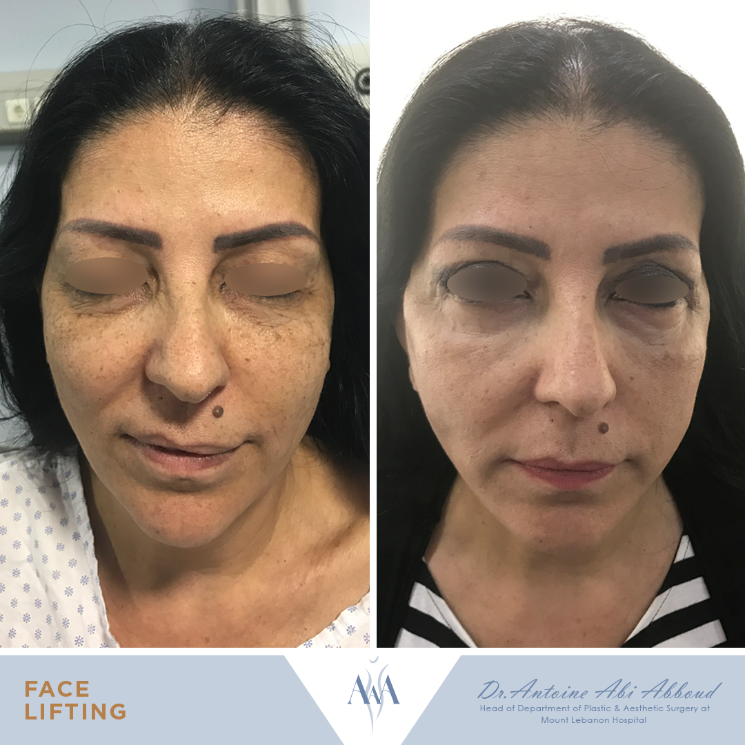 Face & Neck Lift before and after — case 8