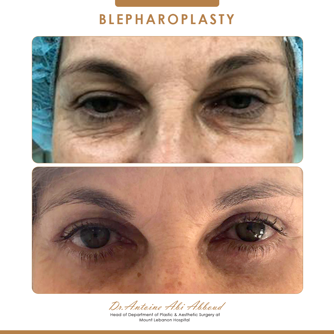 Blepharoplasty before and after — case 6