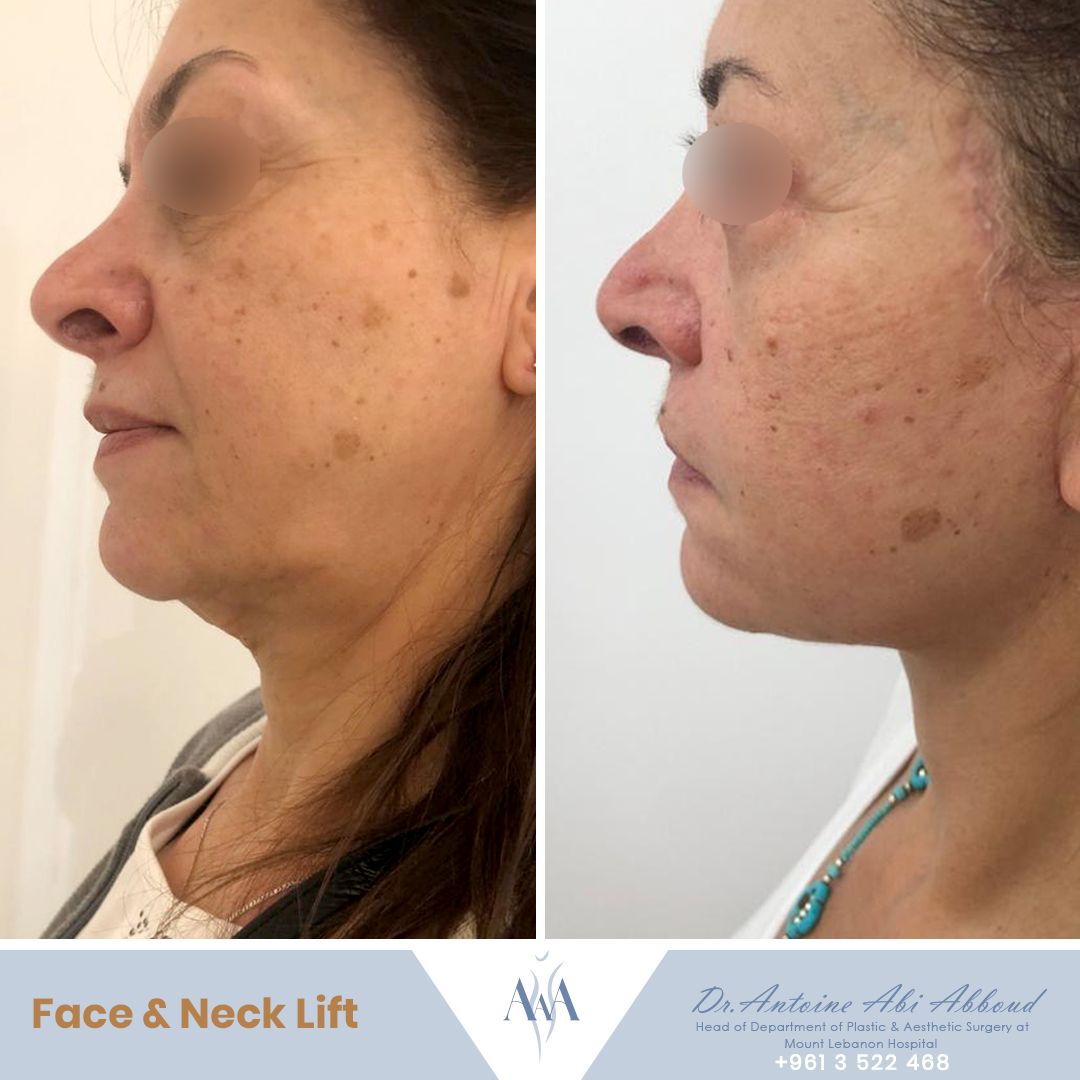 Face & Neck Lift before and after — case 6