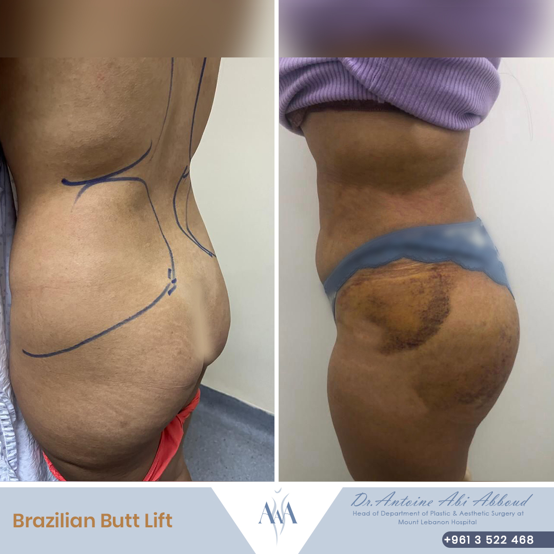 Butt Lipofilling before and after — case 1