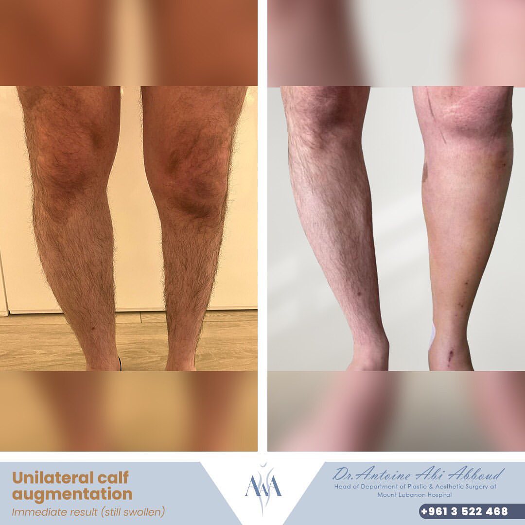Calf Augmentation before and after — case 1