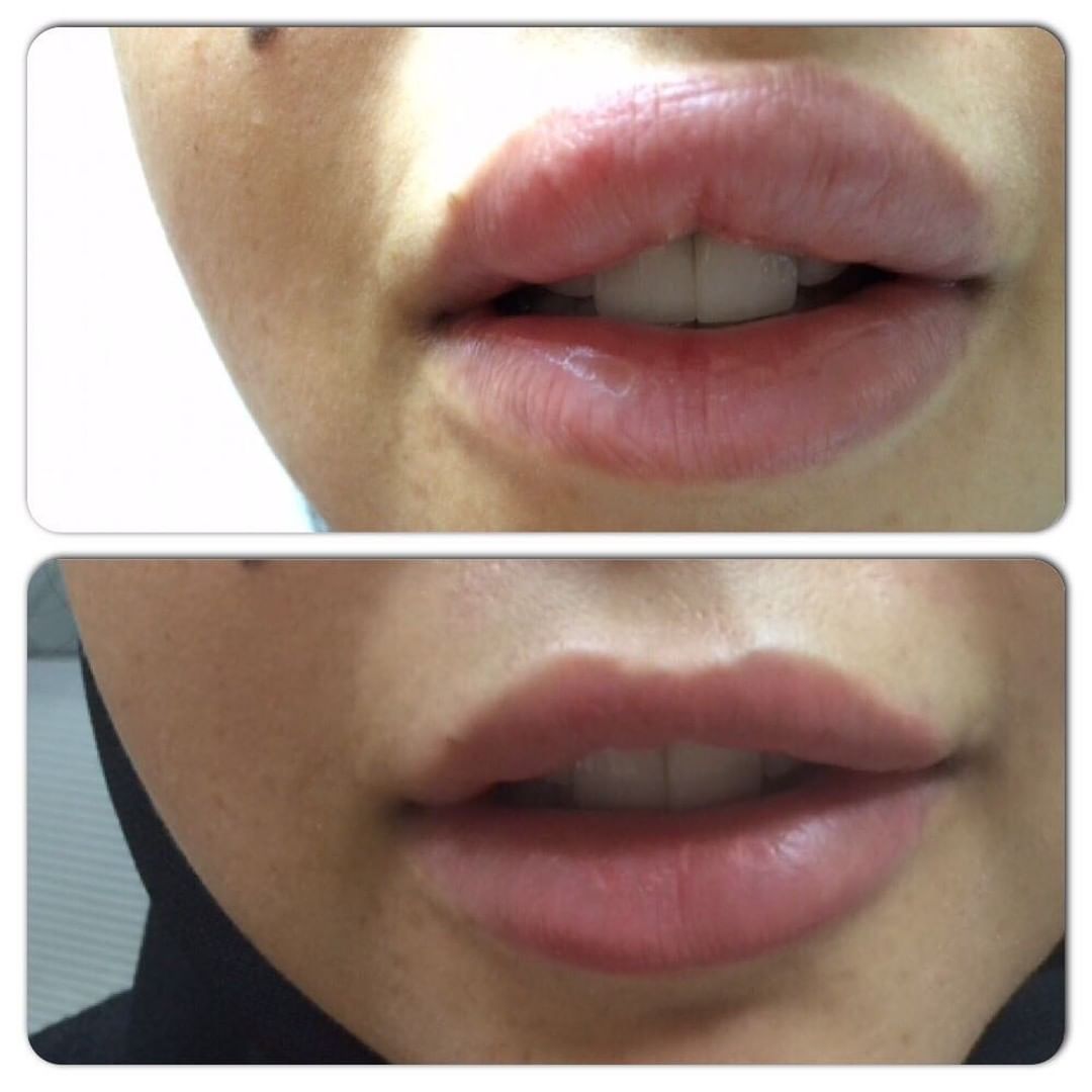 Lip Surgery before and after — case 1