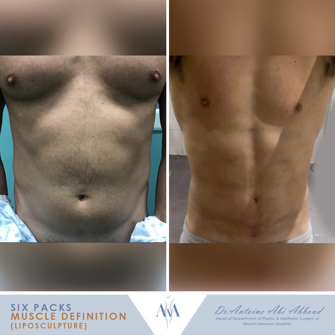 Liposuction before and after — case 1