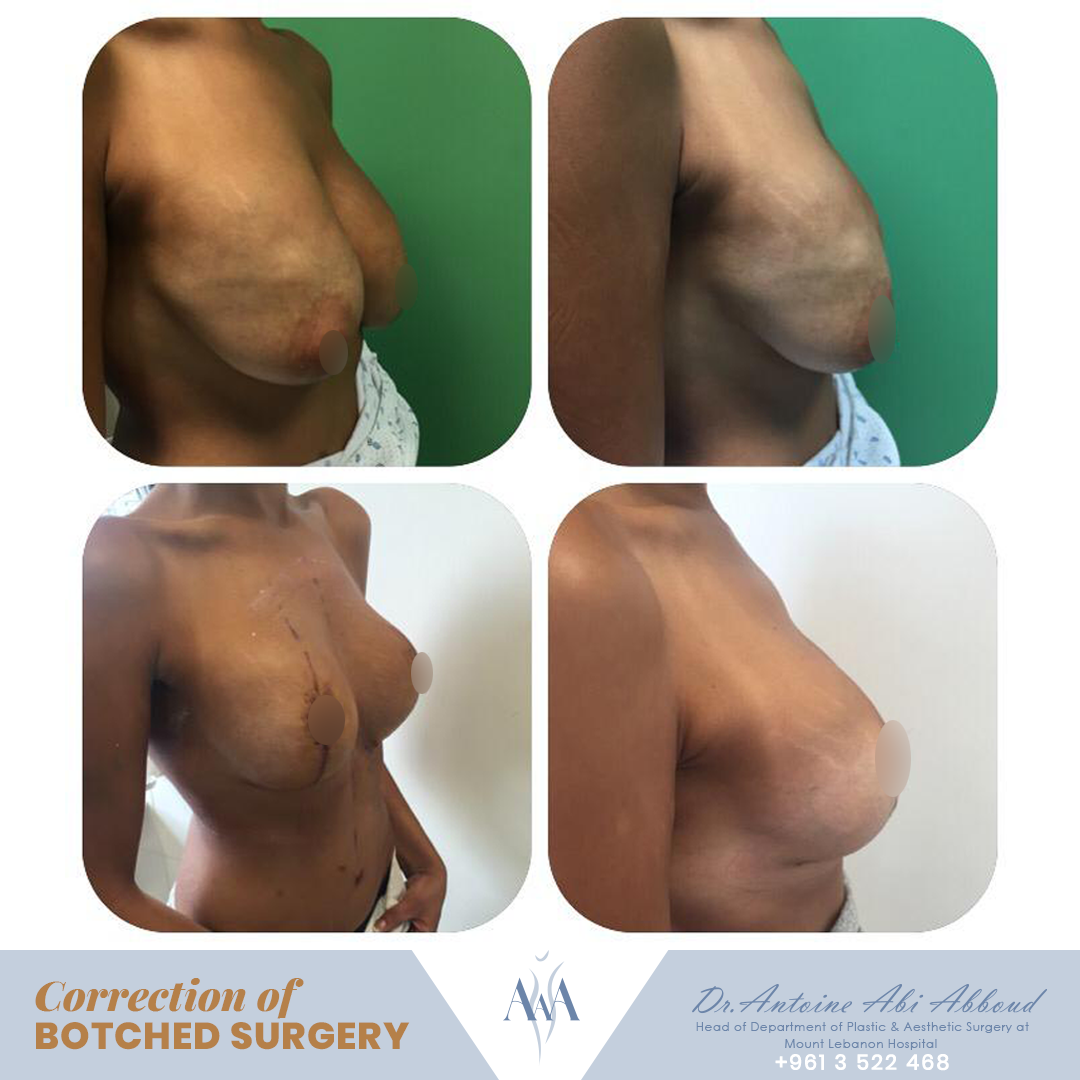 Mastopexy (Breast Lift) before and after — case 3