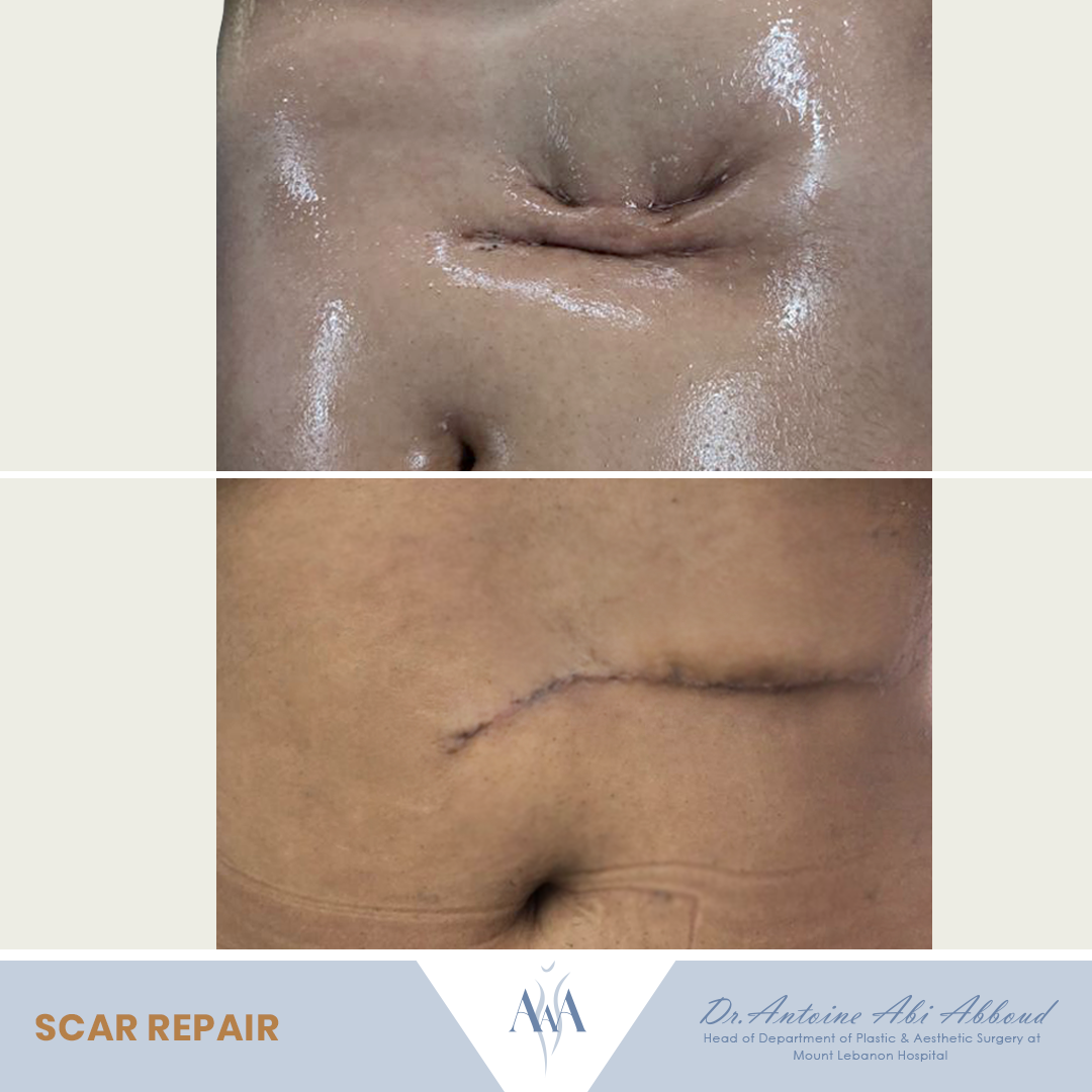 Scars before and after — case 1