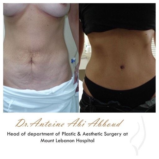 Abdominoplasty before and after — case 3