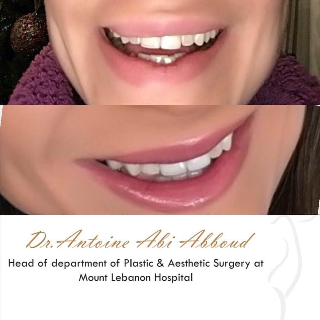 Lip Surgery before and after — case 2