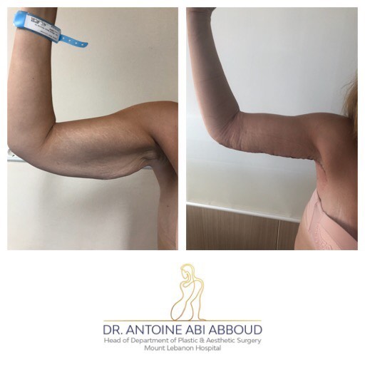 Arm Lift before and after — case 2