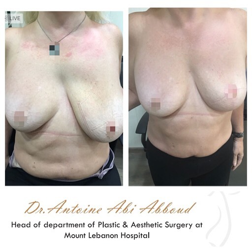 Breast Symmetrisation before and after — case 1