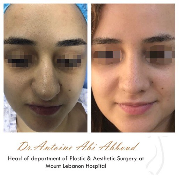 Nose Surgery before and after — case 2