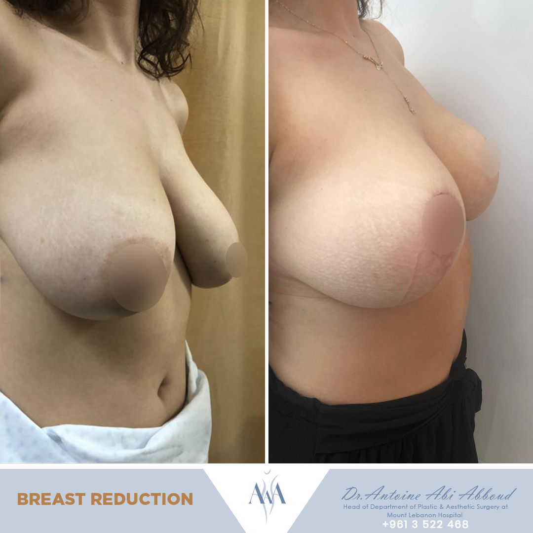 Breast Reduction before and after — case 7