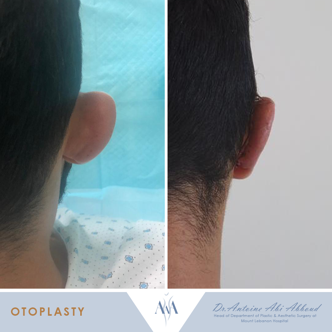 Otoplasty before and after — case 2