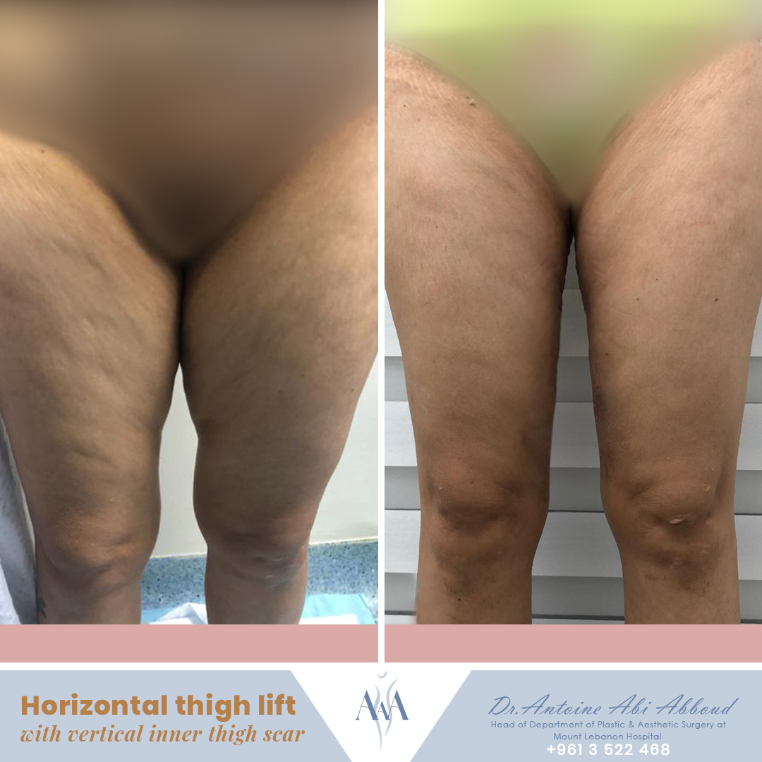Thigh Lift before and after — case 1