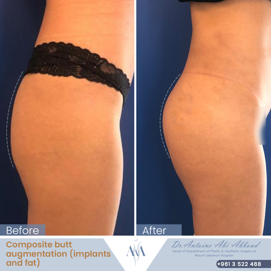 Butt Augmentation before and after — case 4