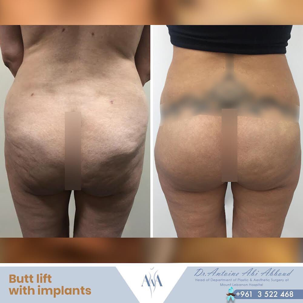 Butt Augmentation before and after — case 1