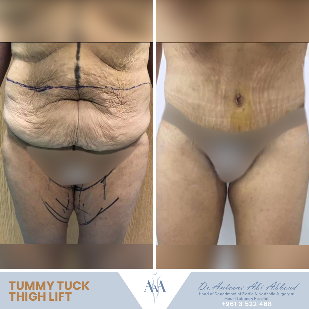 Mommy Makeover before and after — case 6