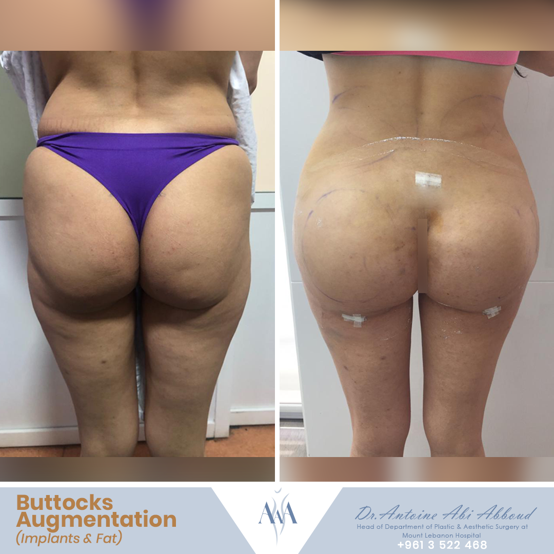 Butt Augmentation before and after — case 6