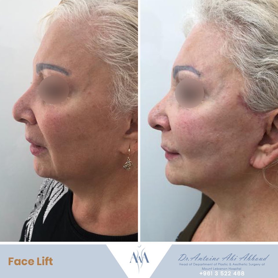 Face & Neck Lift before and after — case 4