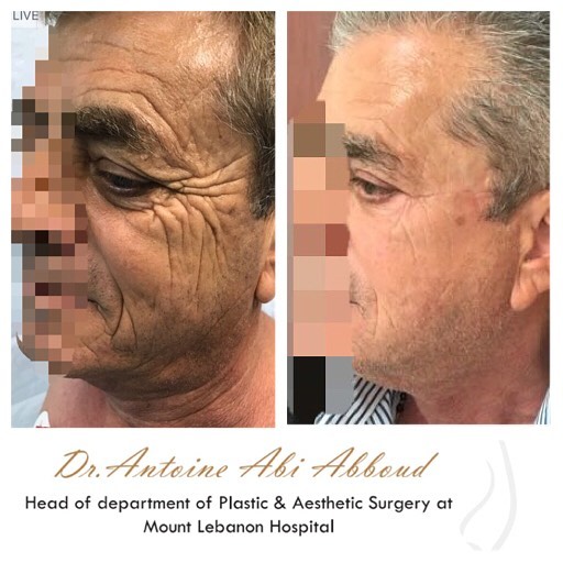 Face & Neck Lift before and after — case 3