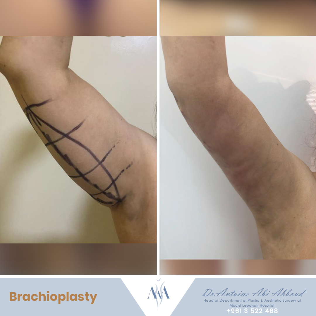 Arm Lift before and after — case 6