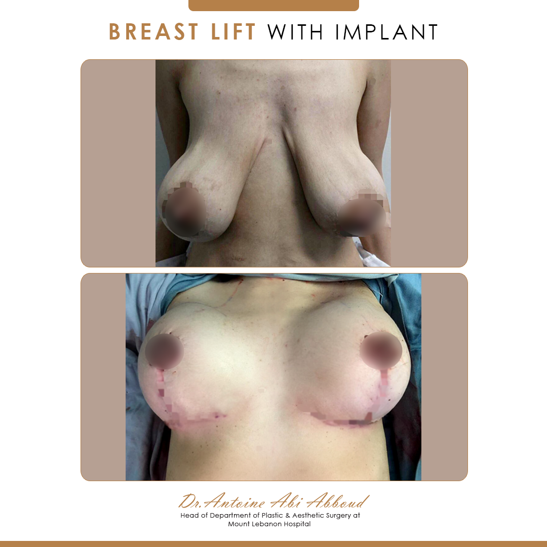 Mastopexy (Breast Lift) before and after — case 4