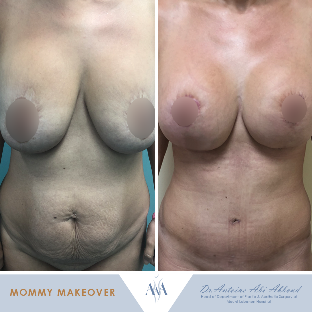 Mommy Makeover before and after — case 3