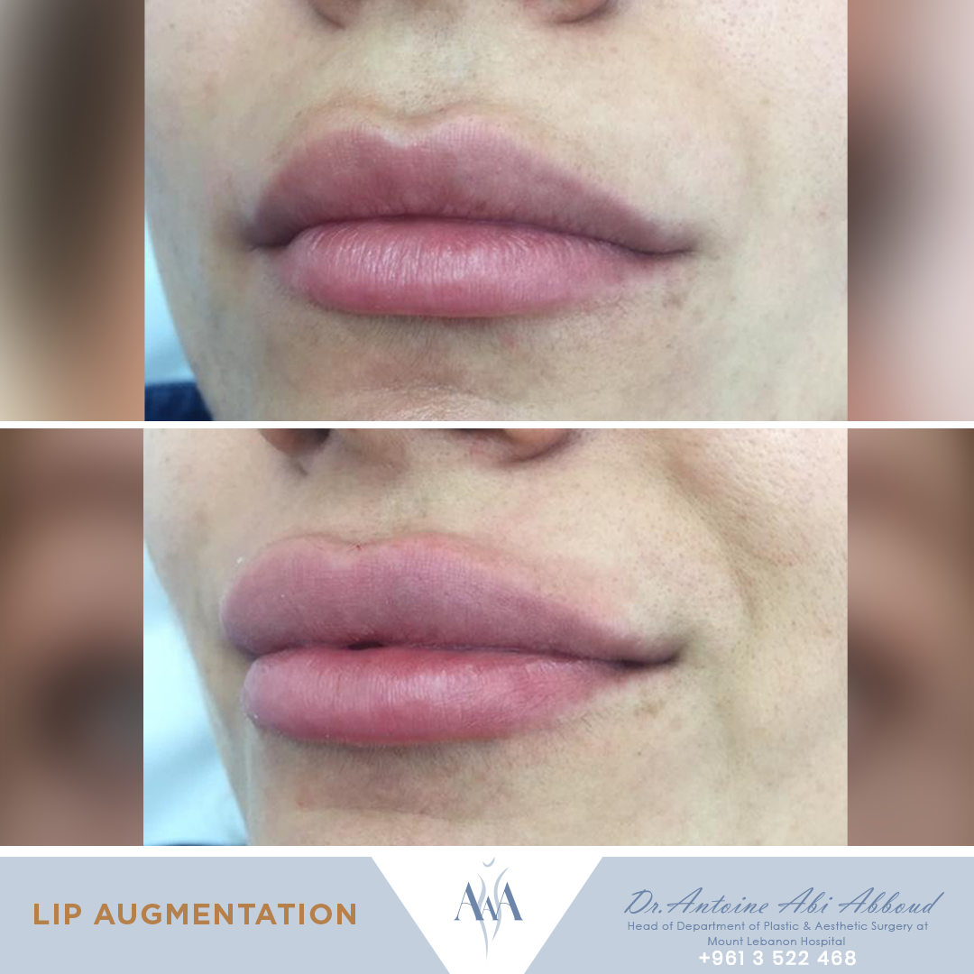 Fillers before and after — case 3