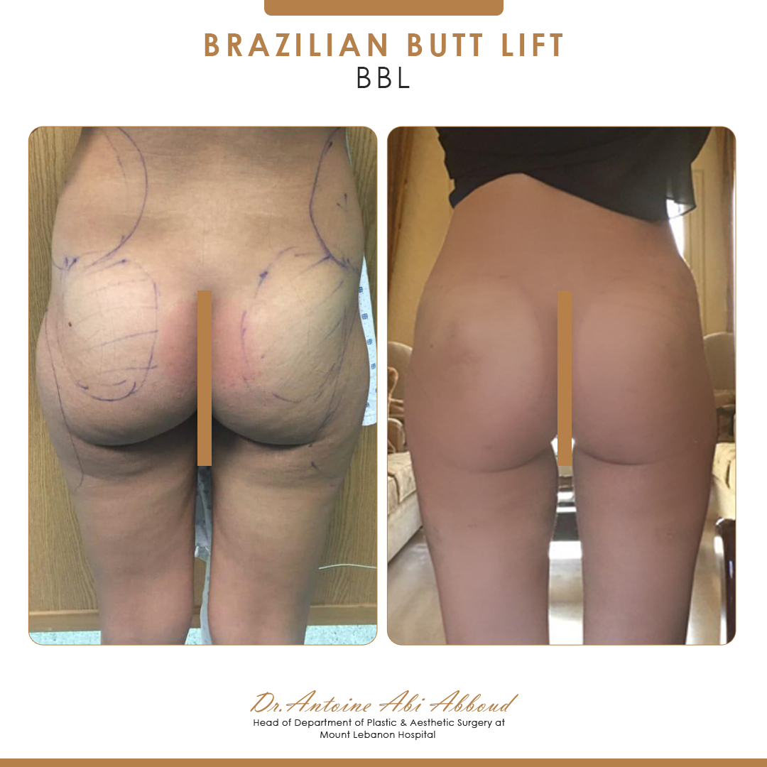 Butt Lipofilling before and after — case 5