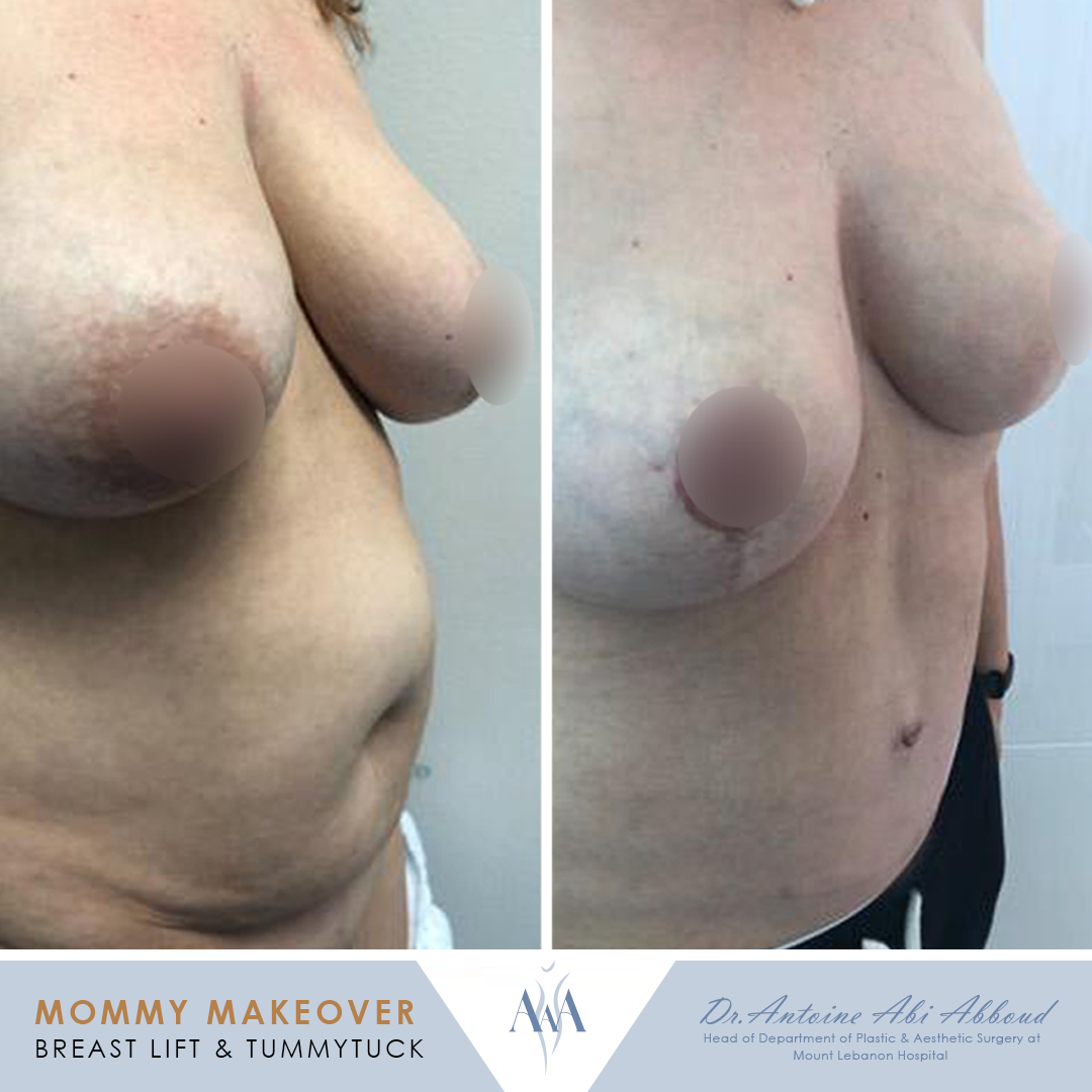 Mommy Makeover before and after — case 4