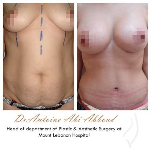 Abdominoplasty before and after — case 1