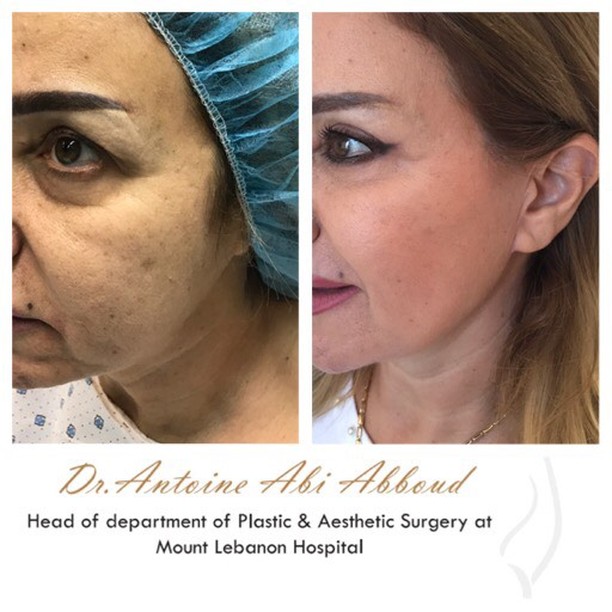 Face & Neck Lift before and after — case 1