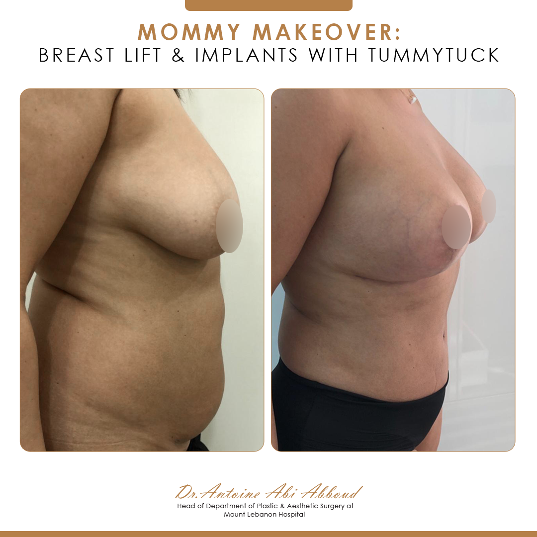 Mommy Makeover before and after — case 7