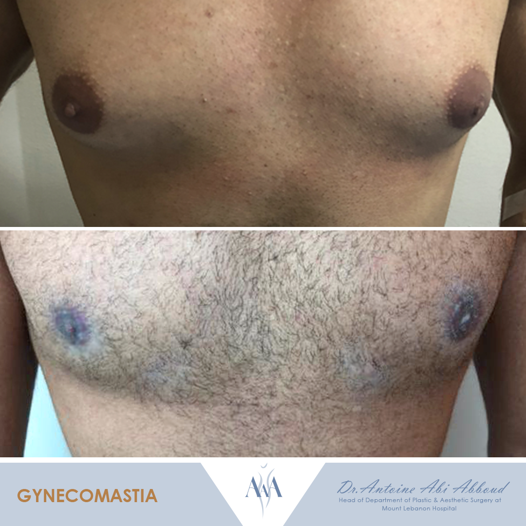 Gynecomastia before and after — case 6