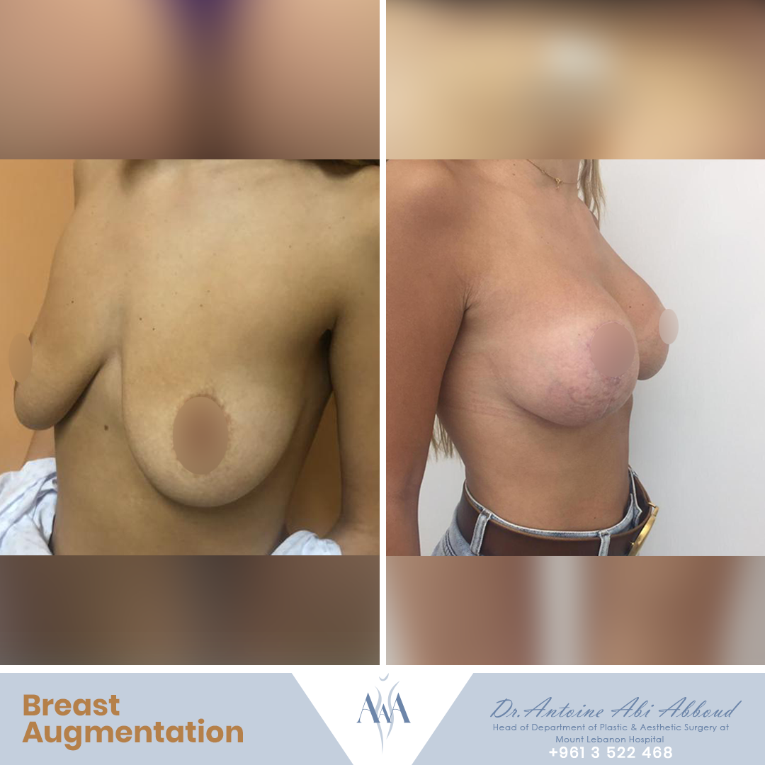 Mastopexy (Breast Lift) before and after — case 8